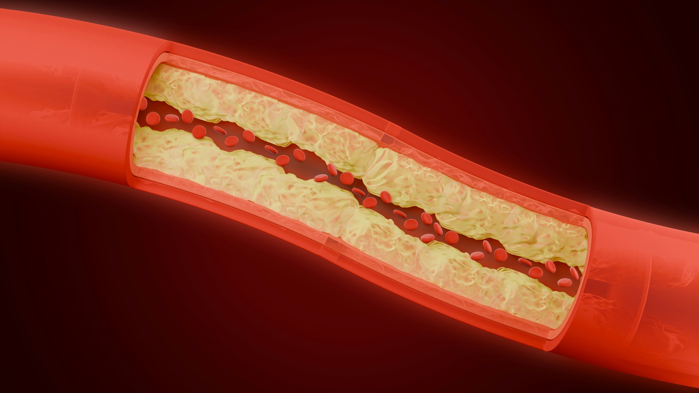 Microplastics drive plaque buildup in arteries of male mice, study suggests